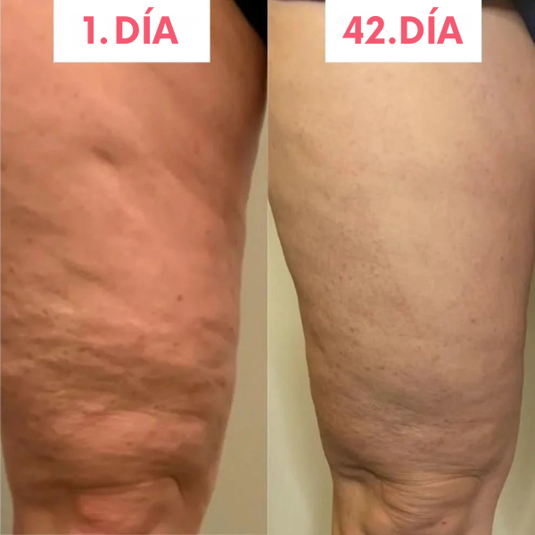Masajeador anticelulitis con calor y succión