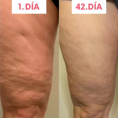 Masajeador anticelulitis con calor y succión