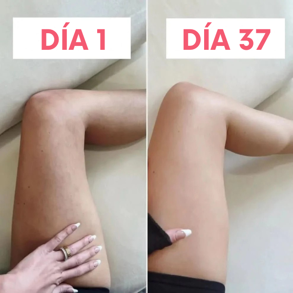 Masajeador anticelulitis con calor y succión